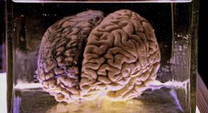 Preserved human brain in a formaldehyde jar