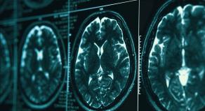 MRI or magnetic resonance image of head and brain scan