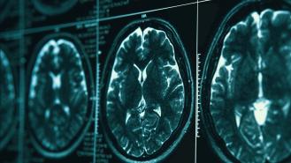 MRI or magnetic resonance image of head and brain scan
