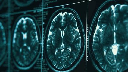 MRI or magnetic resonance image of head and brain scan