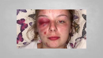 The photo Ellie Williams posted on social media depicting herself with serious facial injuries