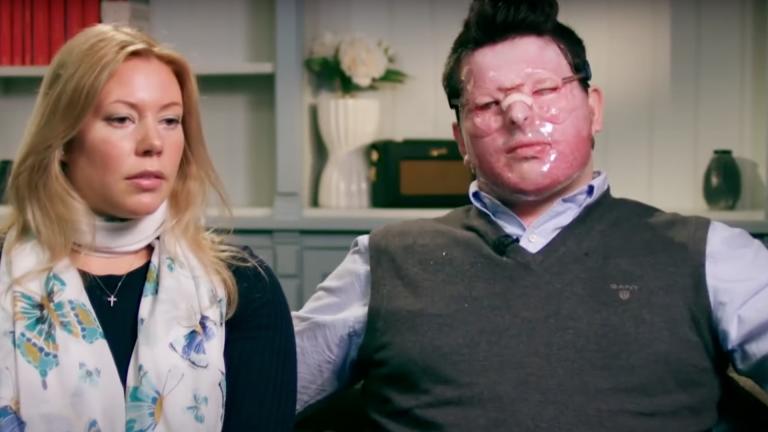 A man with visible scars from an acid attack sits with his wife