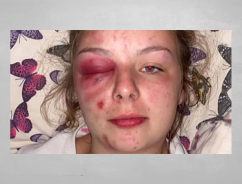 The photo Ellie Williams posted on social media depicting herself with serious facial injuries