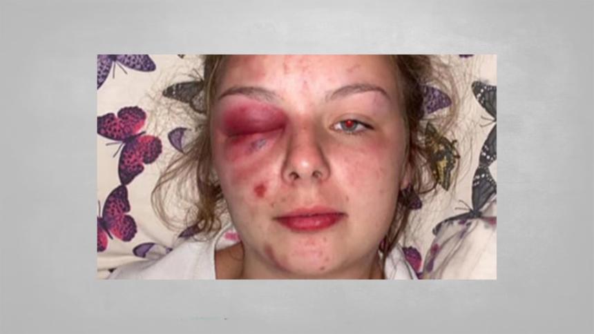 The photo Ellie Williams posted on social media depicting herself with serious facial injuries